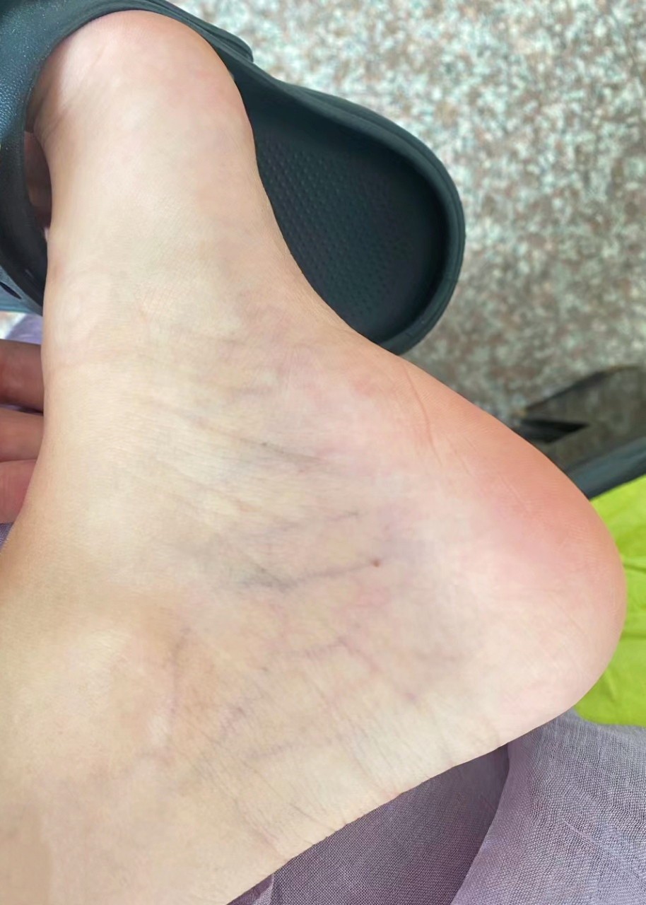 脚踝那么多血丝,正常吗?