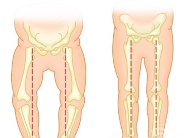 新生儿的小腿弯曲怎么办?别担心