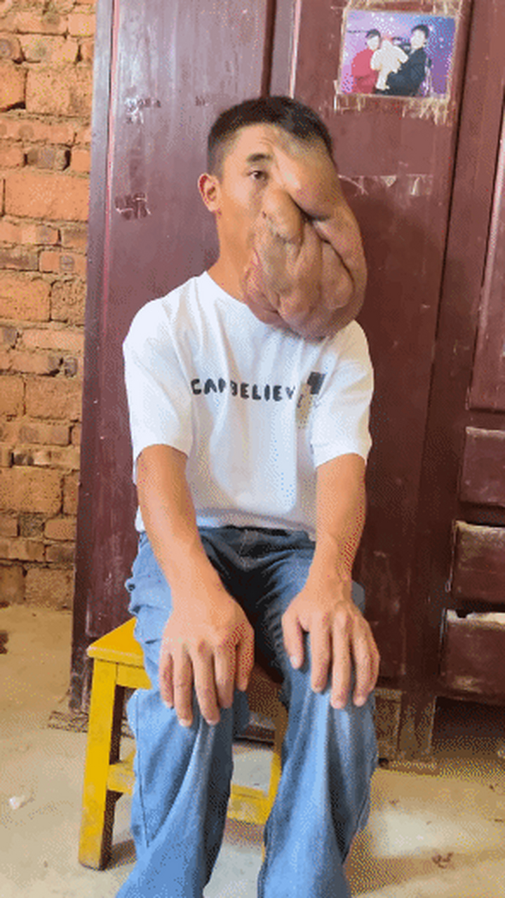 贵州小伙脸上长出10多斤纤维瘤导致面部变形左耳失聪,左眼失明.