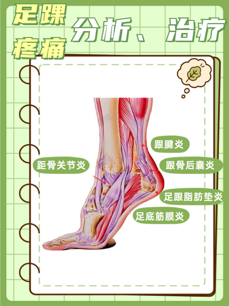 足踝足跟疼痛症状 分析  治疗  治疗方式: 足底筋膜炎 61跖筋膜炎