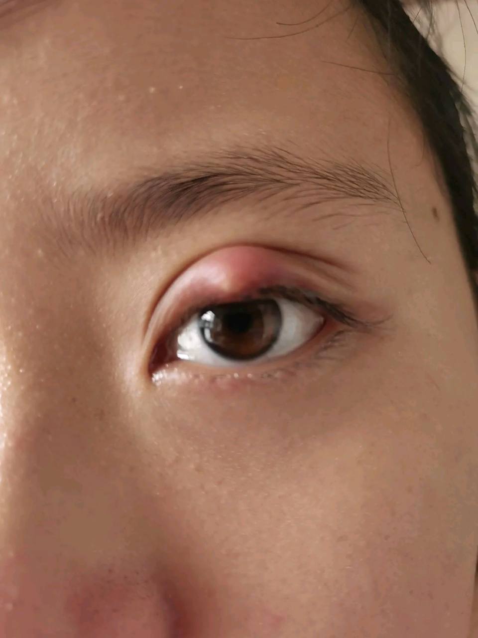 姑娘眼睑上长了个疙瘩,医生建议手术,哪个大神可以告诉我这有没有必要