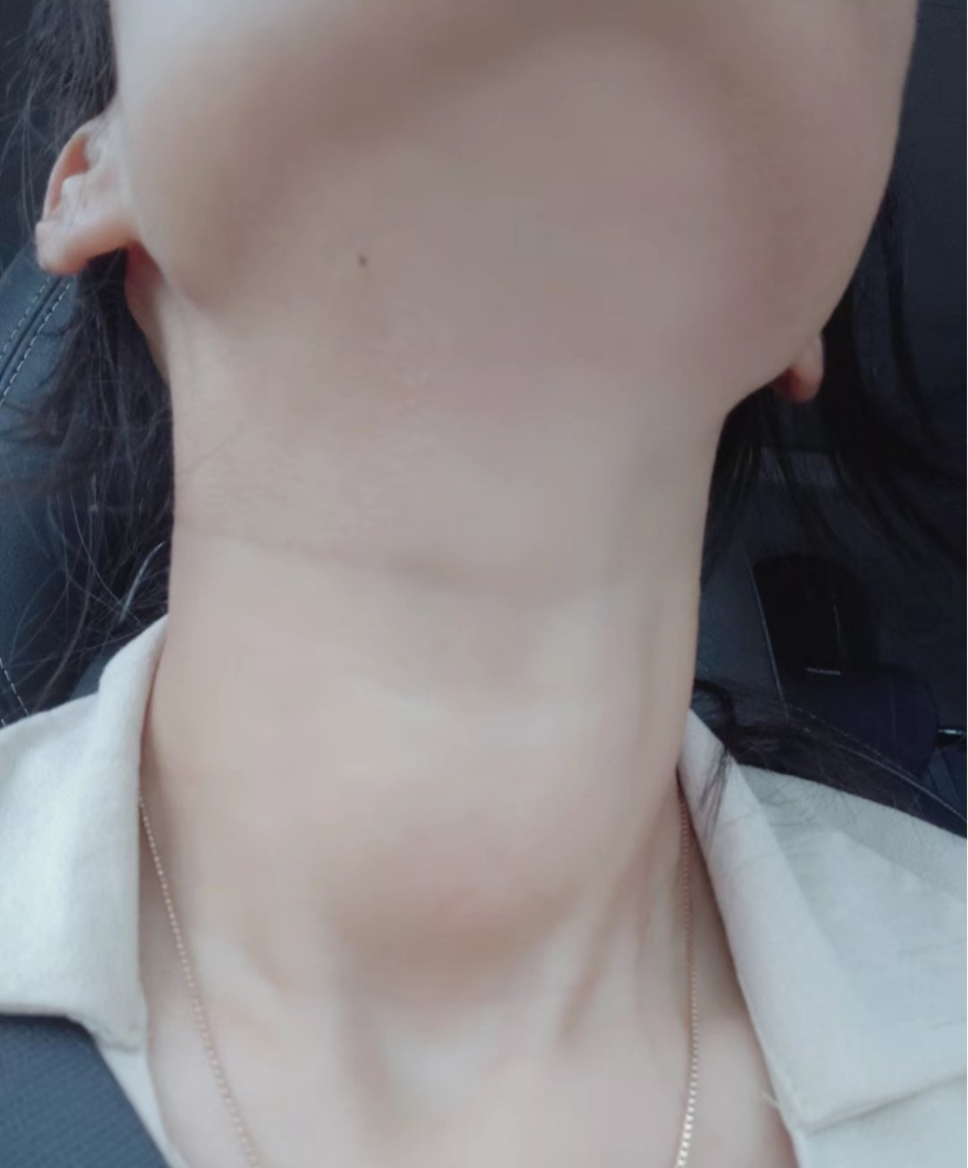 甲亢好了!终于不用再受大脖子的困扰了!