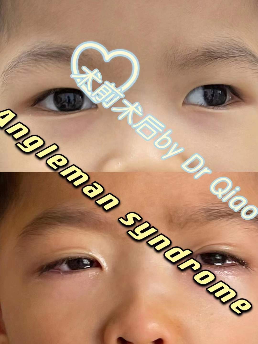 斜视手术各种案例分享