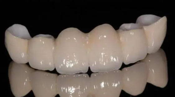 牙齿贴面好还是全瓷牙好?选错一步毁牙一生全瓷贴面可以维持多久