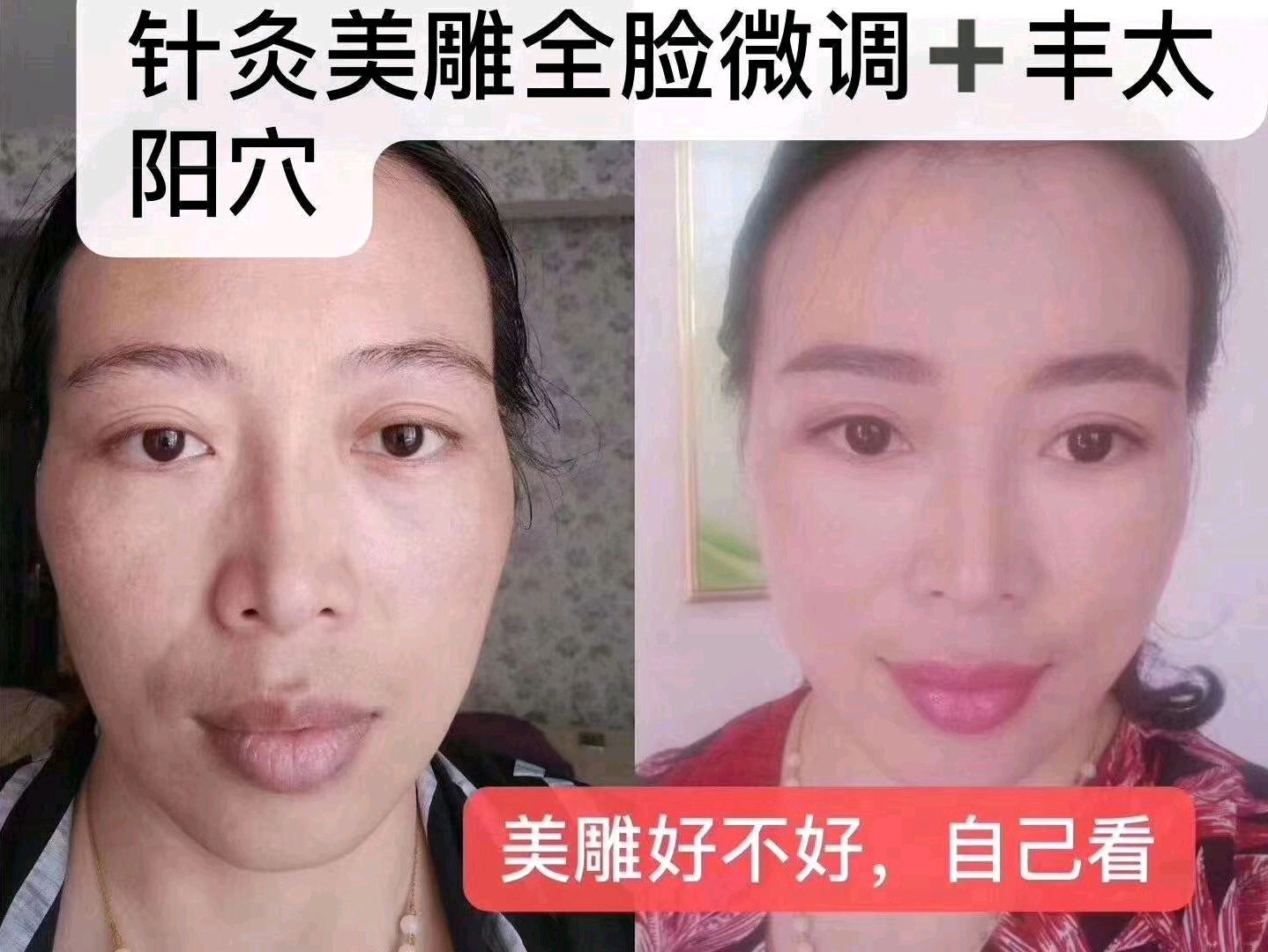 济南针灸美雕培训天健针灸美雕