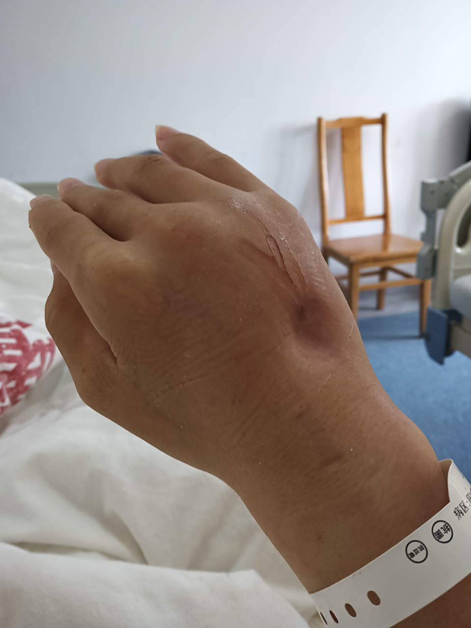 手都肿了,就像冬天里挨冻的萝卜,钻心的疼,左手换右手,右手换左手