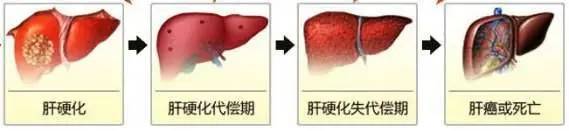 肝硬化失代偿期图片