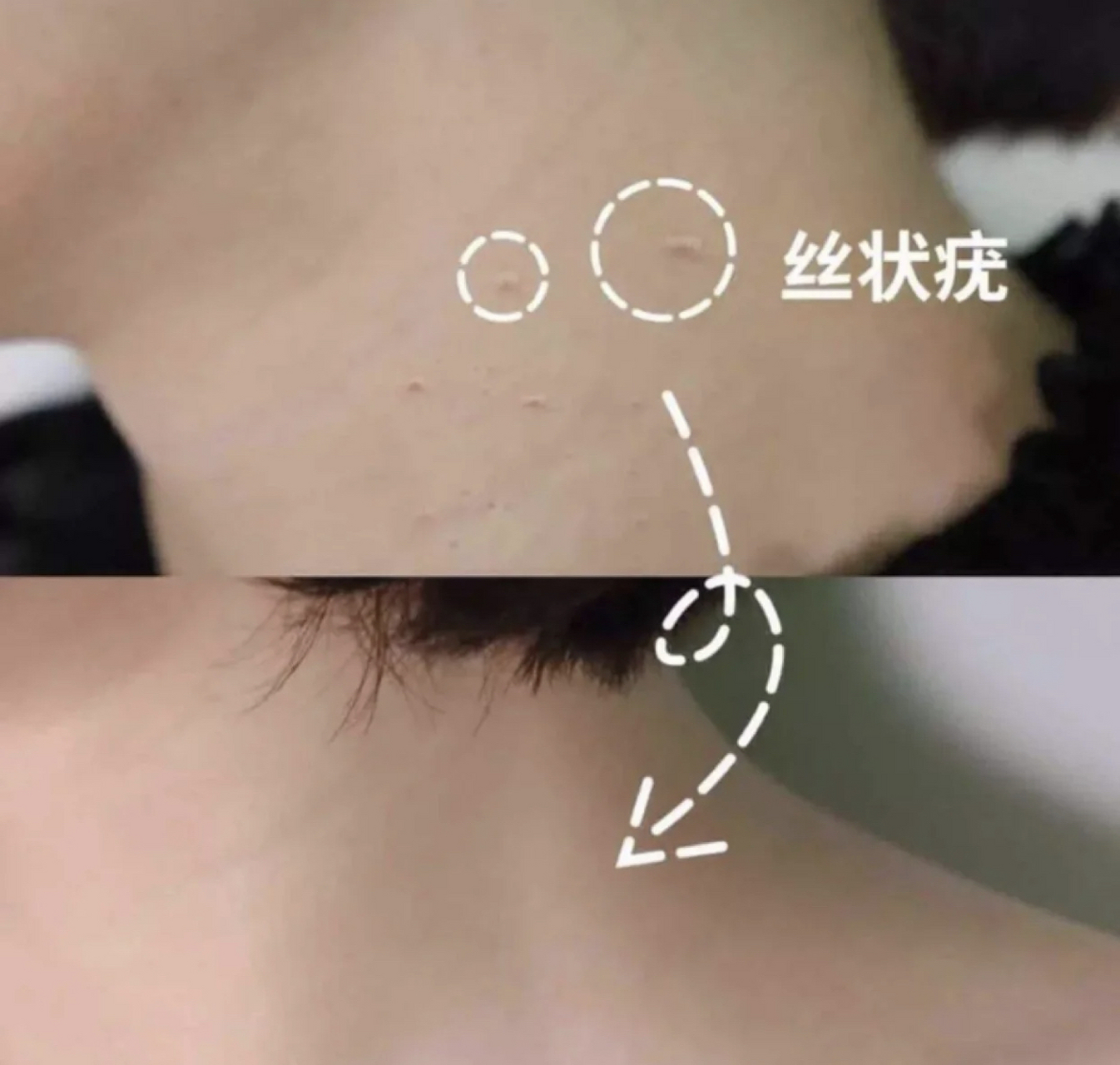 其实,它们叫【丝状疣】,  是hpv病毒感染所引起的,  顶端一般比较