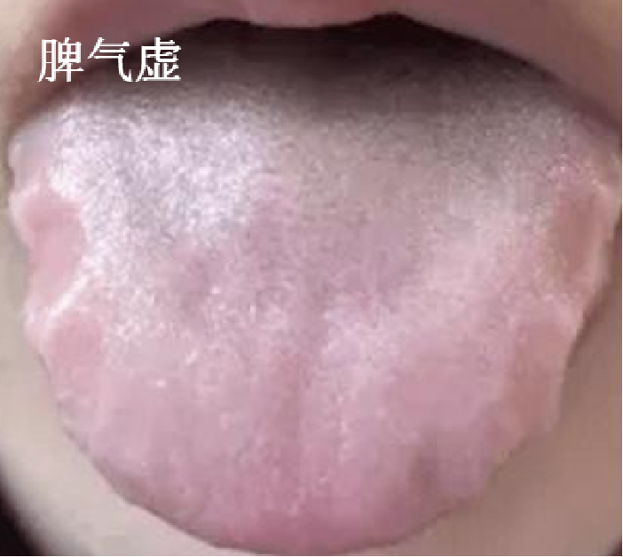 齿痕舌的虚与湿,4种常见齿痕舌问题