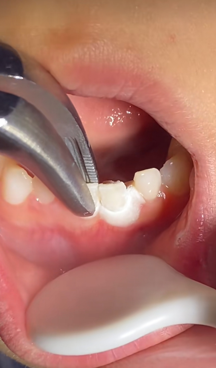 现在的人啊,乳牙会自己掉,你非得人工给拔掉,不知道怎么想的[汗]