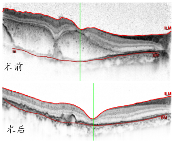 温医大附属眼视光医院吴荣瀚主任突破手术禁区为患者守住最后光明