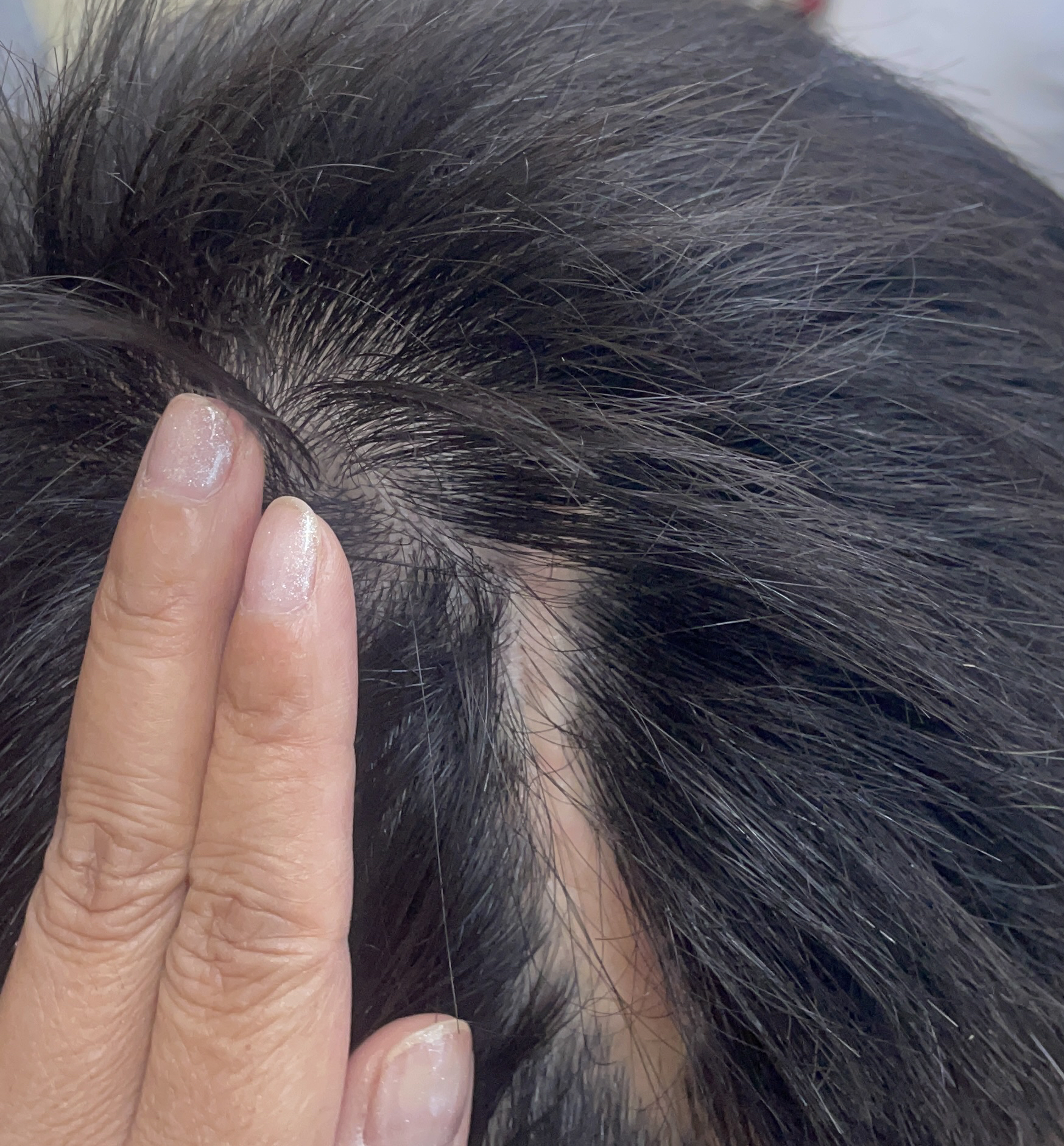 头部瘢痕毛发移植治疗方案