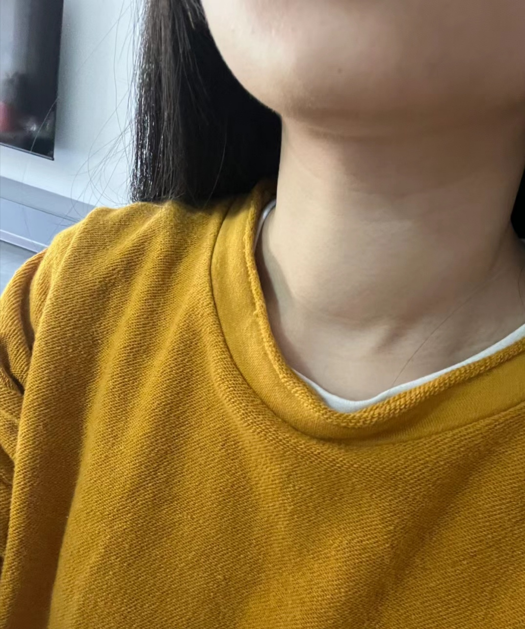 谁说甲亢永远不会好?看看对比图