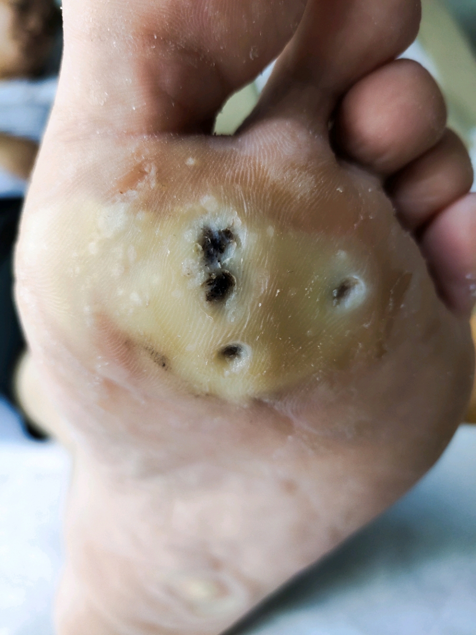 脚底长了4个鸡眼,走起路来疼得要命,经过一段时间的治疗,现在终于好了