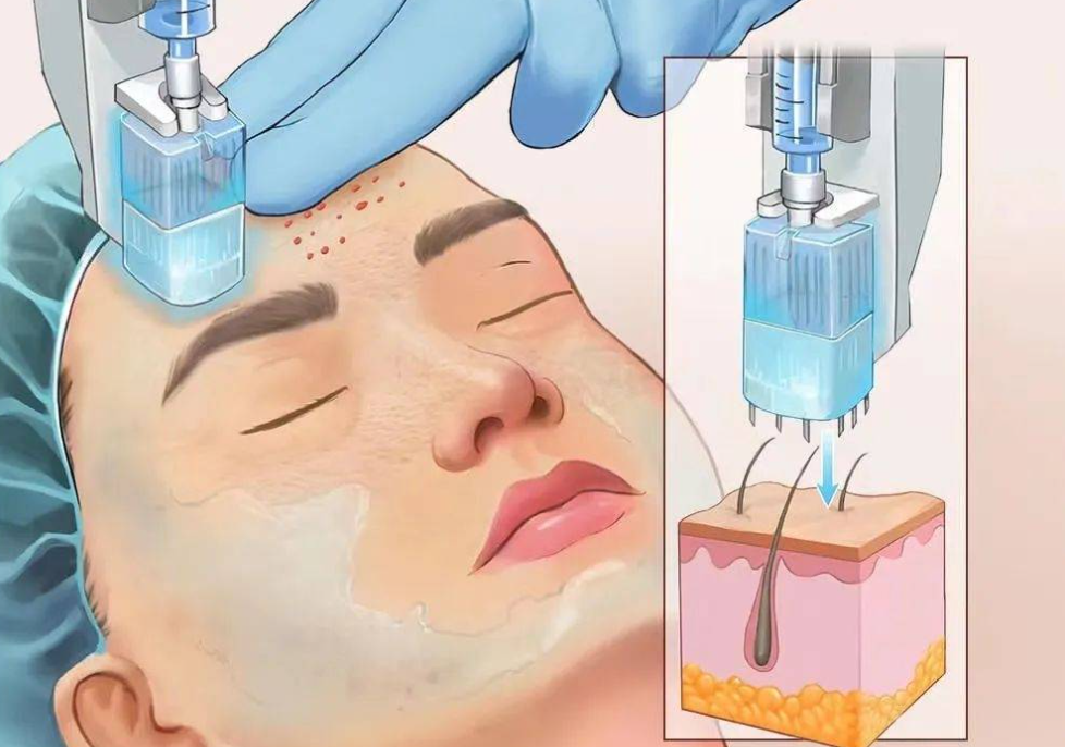 水光针持久性怎么样,无针水光针与有针水光针有什么区别?