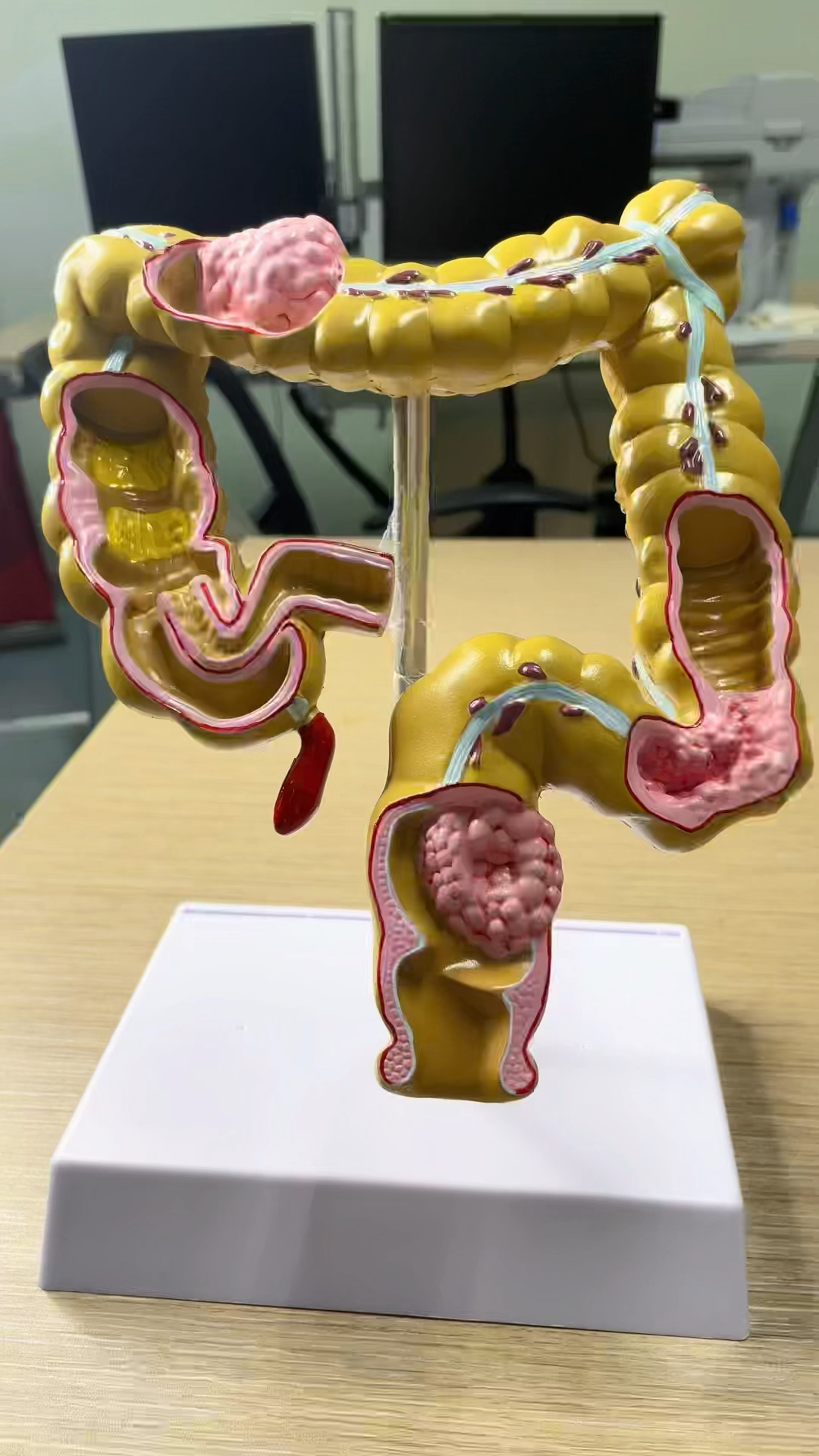 大肠的解剖,曹医生给您讲讲!-度小视