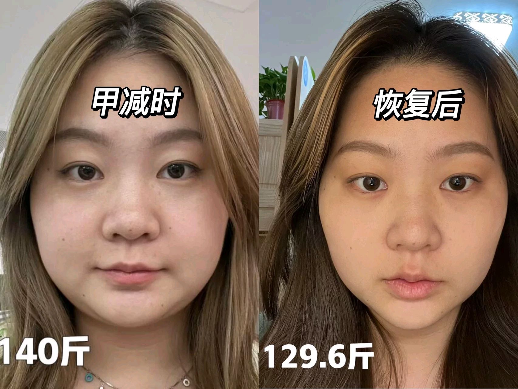 甲减恢复前后对比,光看脸都能看出很大的区别了,那段时间喝水都会胖