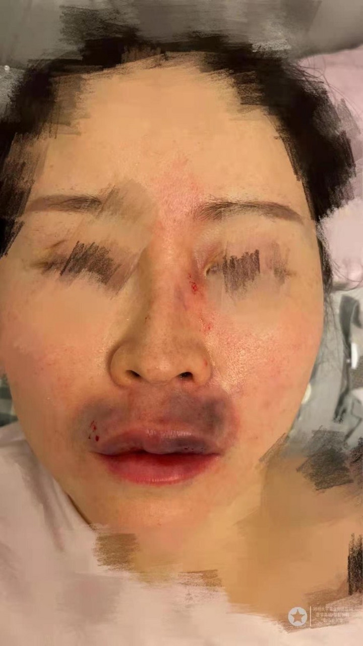晚上接到内蒙古鄂尔多斯求助电话 玻尿酸丰唇局部栓塞,上唇地图状花斑