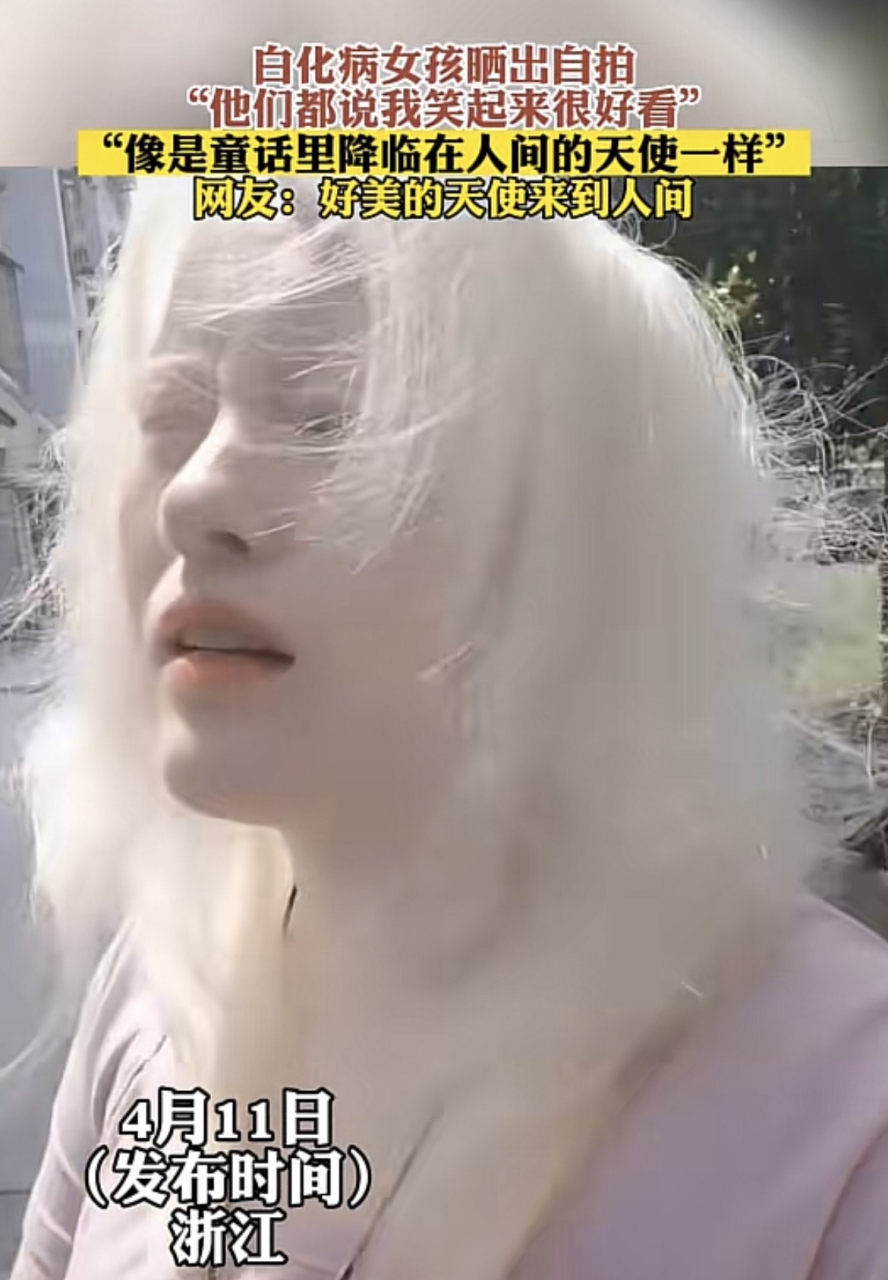 白化病女孩晒出自拍 "他们都说我笑起来很好看"