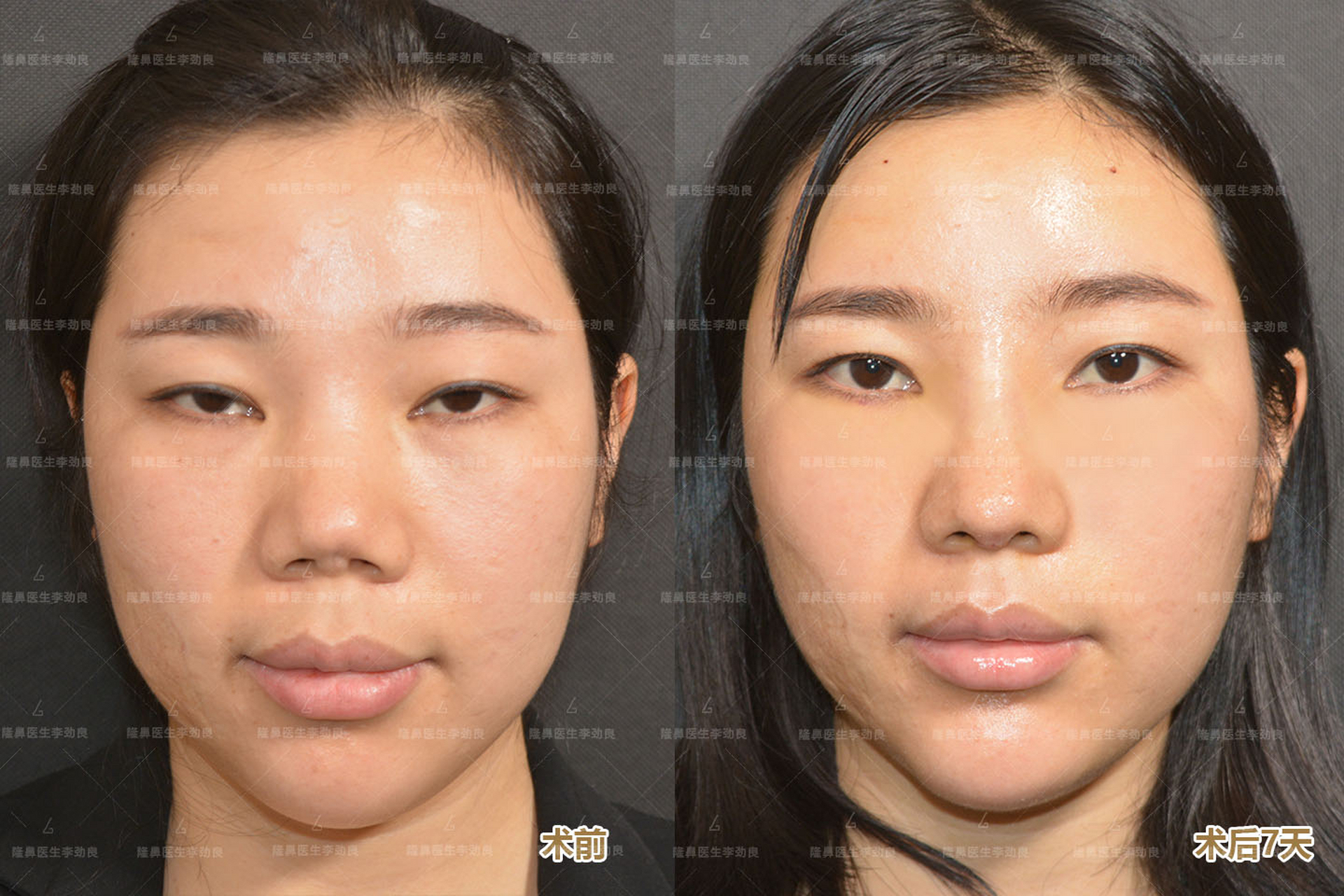 鼻小柱内陷的难度鼻修复案例分享:姑娘术前做过假体 耳软骨,最重要的