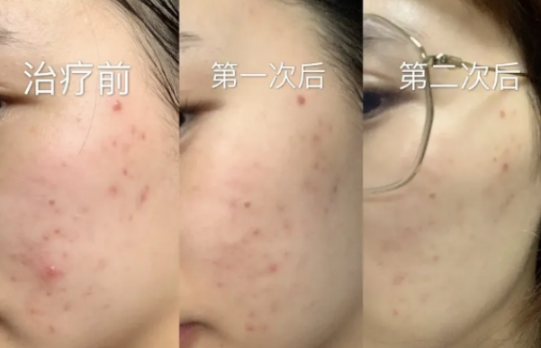 鸡皮肤应该做什么项目(鸡皮肤应该做什么项目治疗)