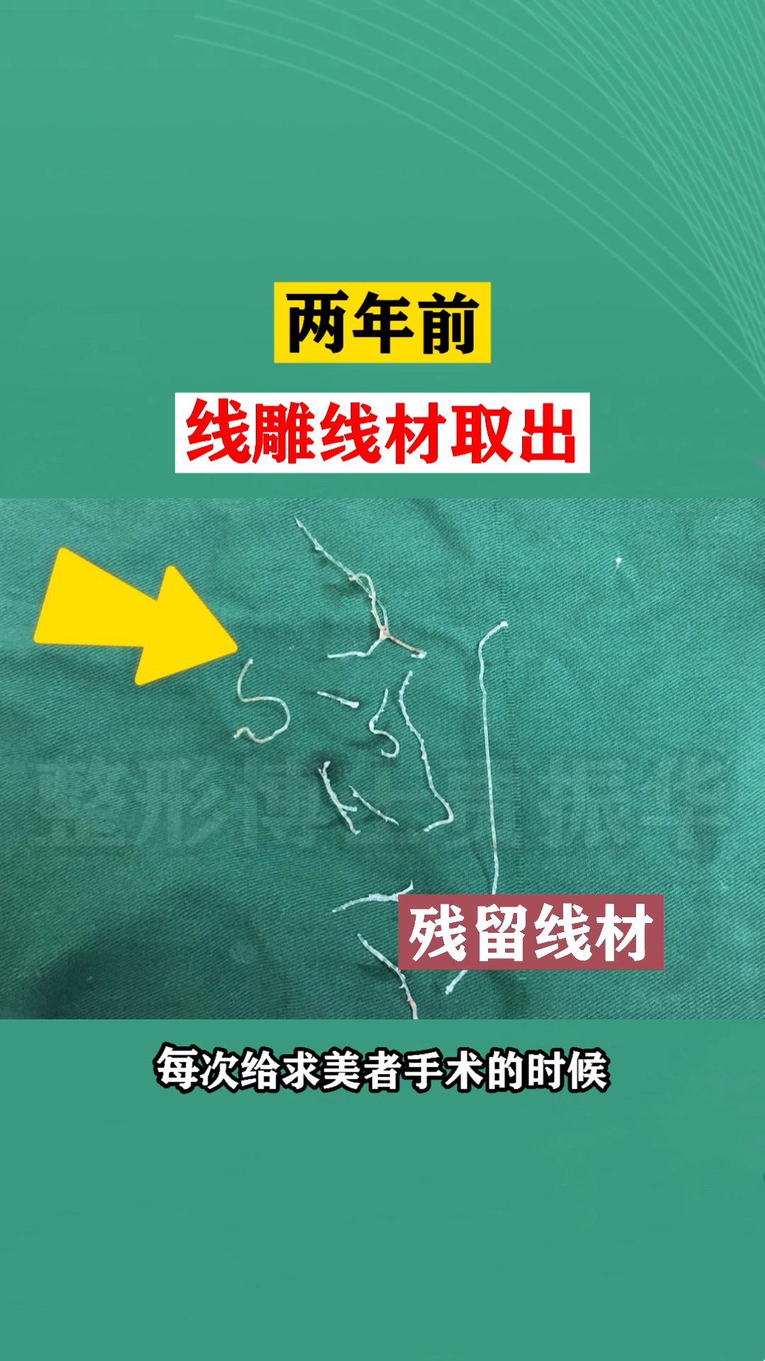 拉皮手术前取出来面部残留已久的线雕线看完这些你还敢去做线雕吗