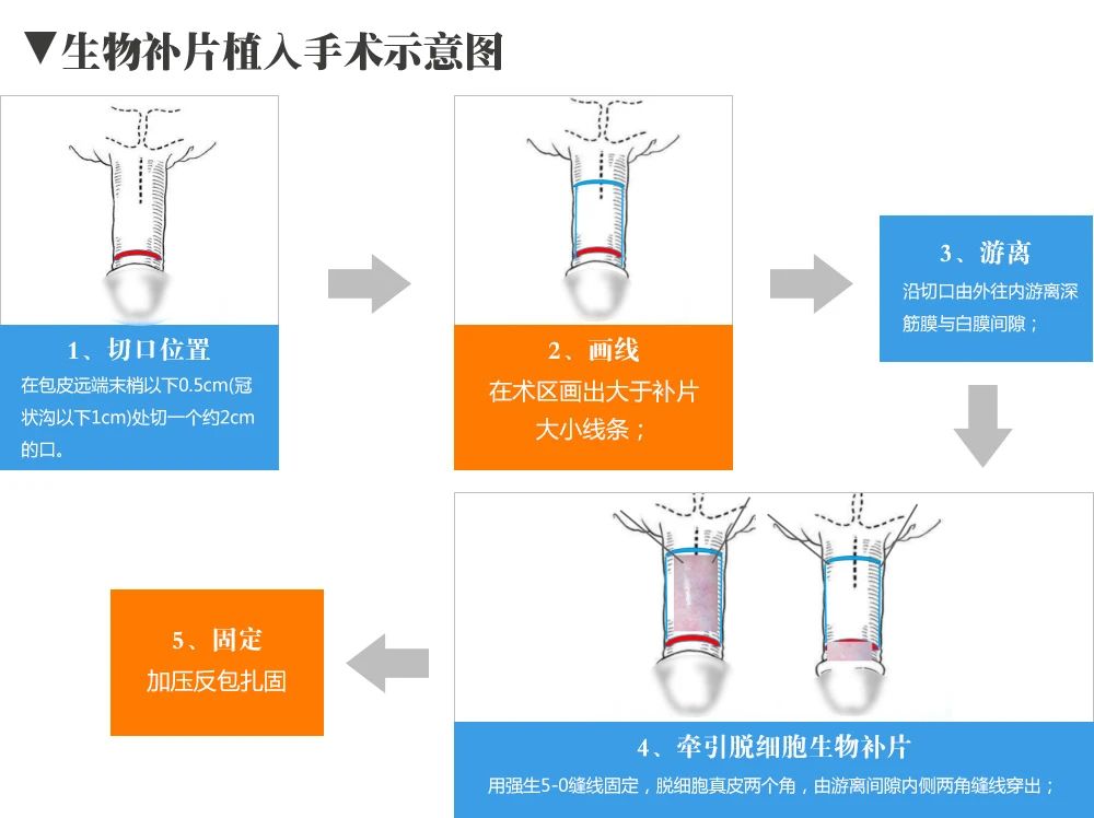 什么是生物补片增粗术?