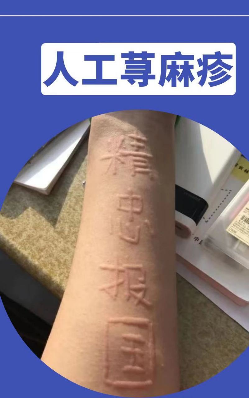 慢性荨麻疹指的是几乎每天都会发生的,持续6周以上的荨麻疹,发病率