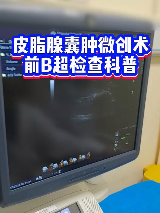 皮脂腺囊肿微创术前b超检查科普