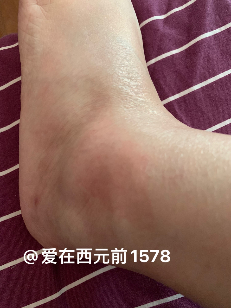 胫腓骨骨折手术后110天 脚踝处肿的厉害,还是不能正常走路.