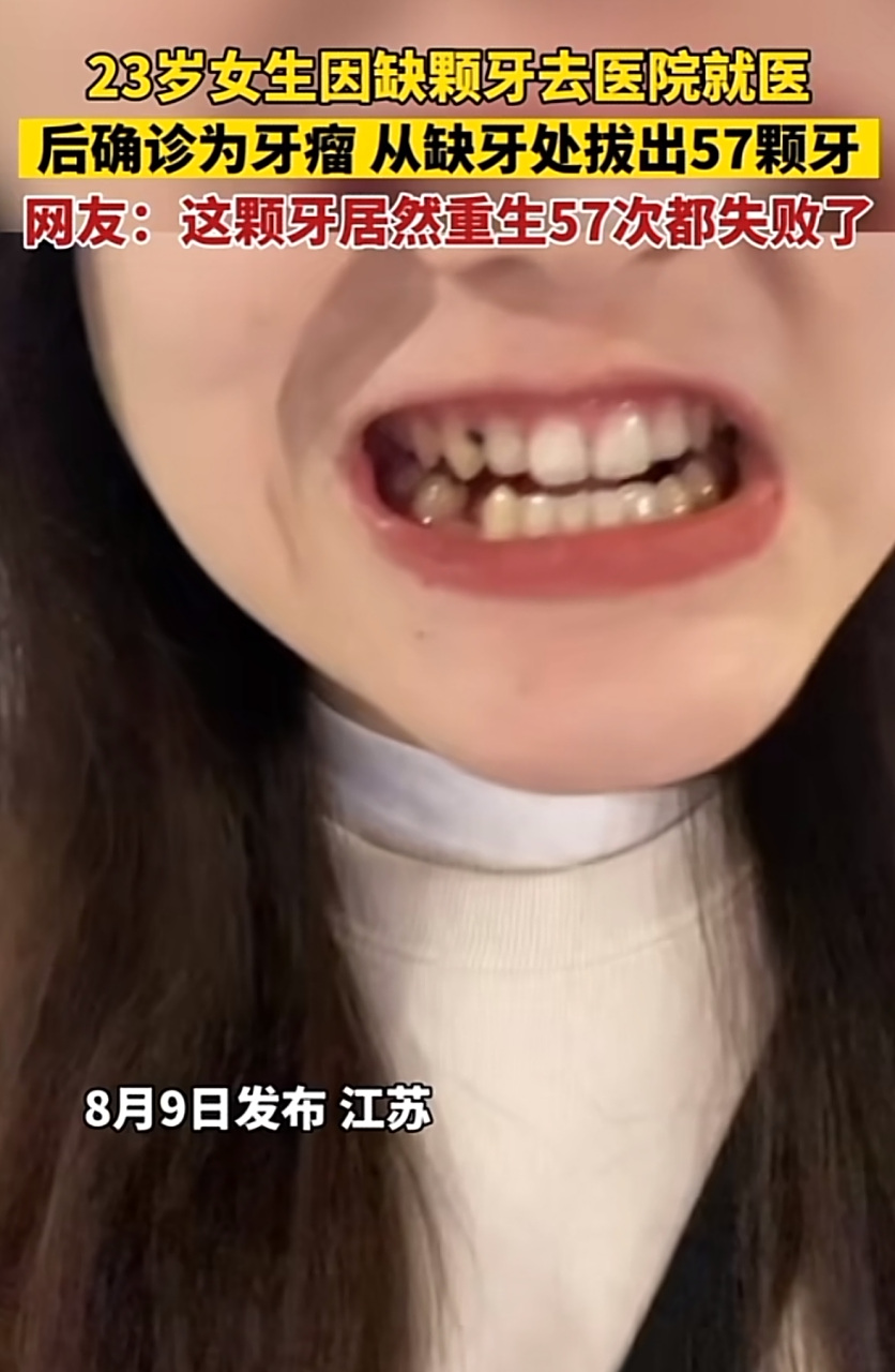 去医院诊断后从缺口处扒出来57颗牙齿,一个小小的牙窝里拔出57颗牙 你