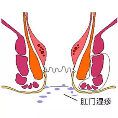 肛门湿疹怎么彻底根治图片