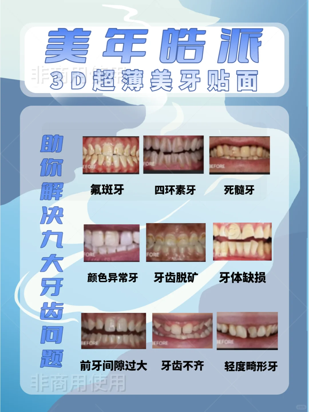 九大陋牙克星——美年皓派超薄美牙贴面