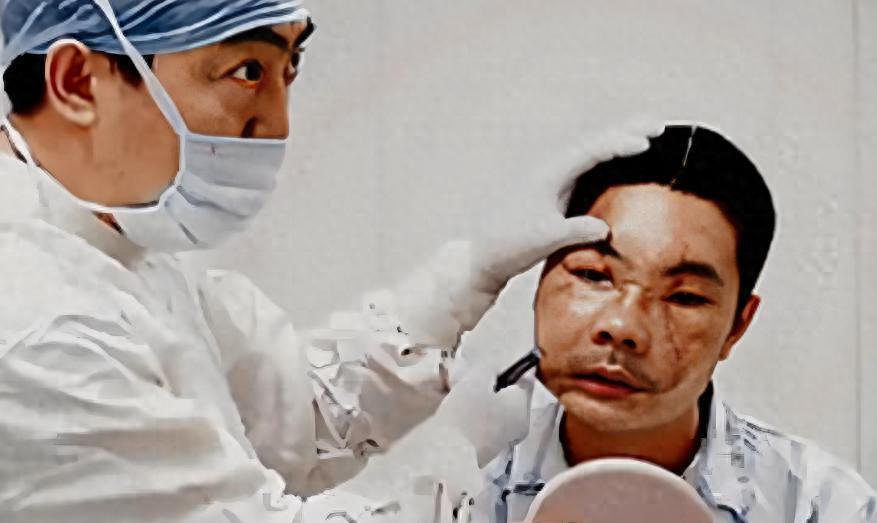 中国换脸第一人李国兴,不听医生劝告执意出院,半年后离奇死亡