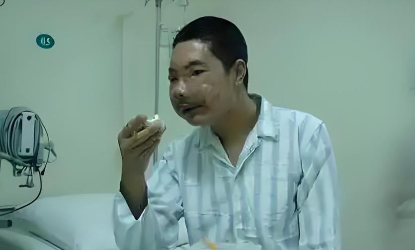 中国换脸第一人李国兴,不听医生劝告执意出院,半年后离奇死亡