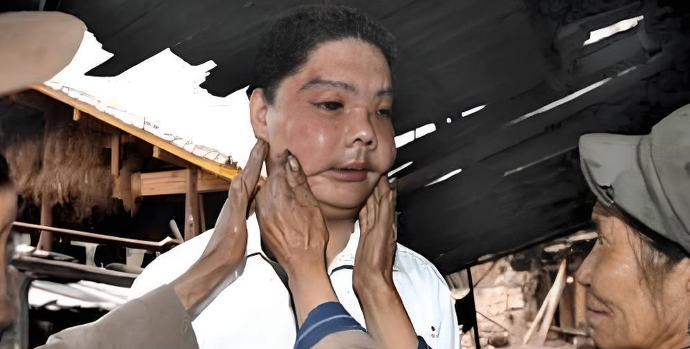 中国换脸第一人李国兴,不听医生劝告执意出院,半年后离奇死亡