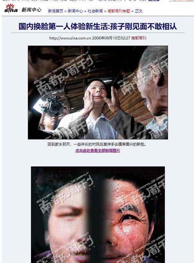 中国换脸第一人李国兴,不听医生劝告执意出院,半年后离奇死亡