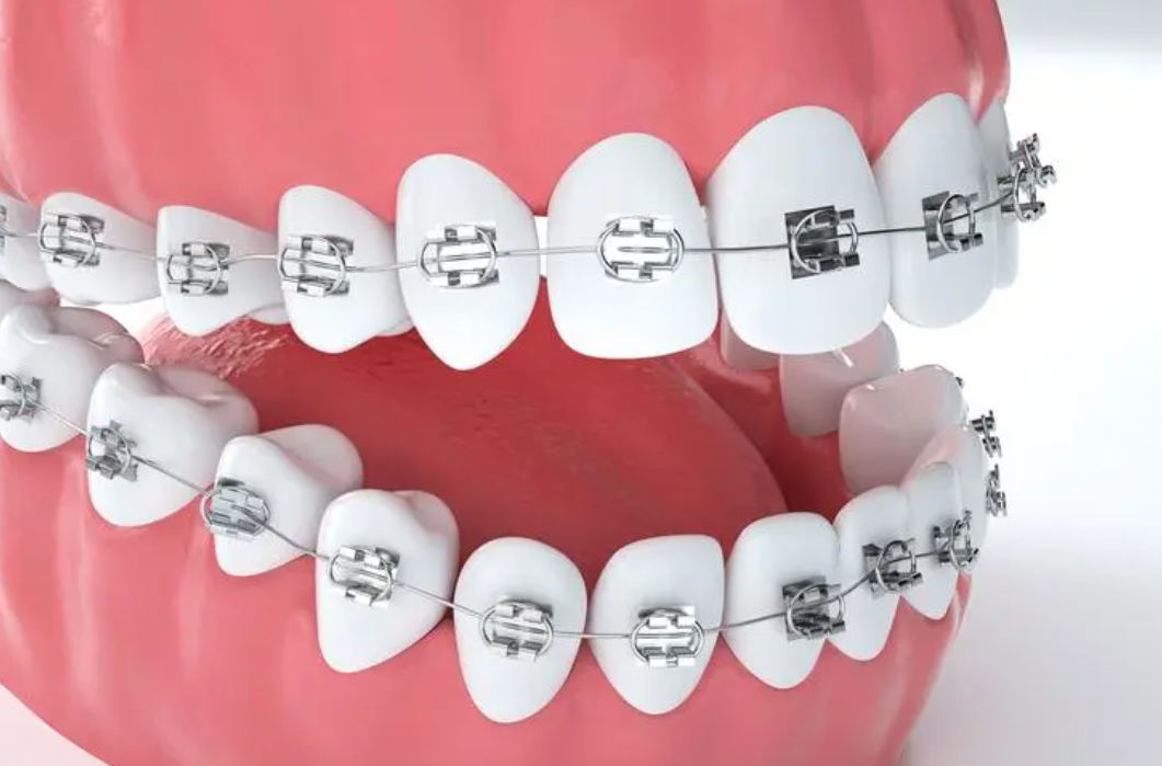 网友吐槽:耗时久,效果差,不断重启……隐形矫正还能做吗?