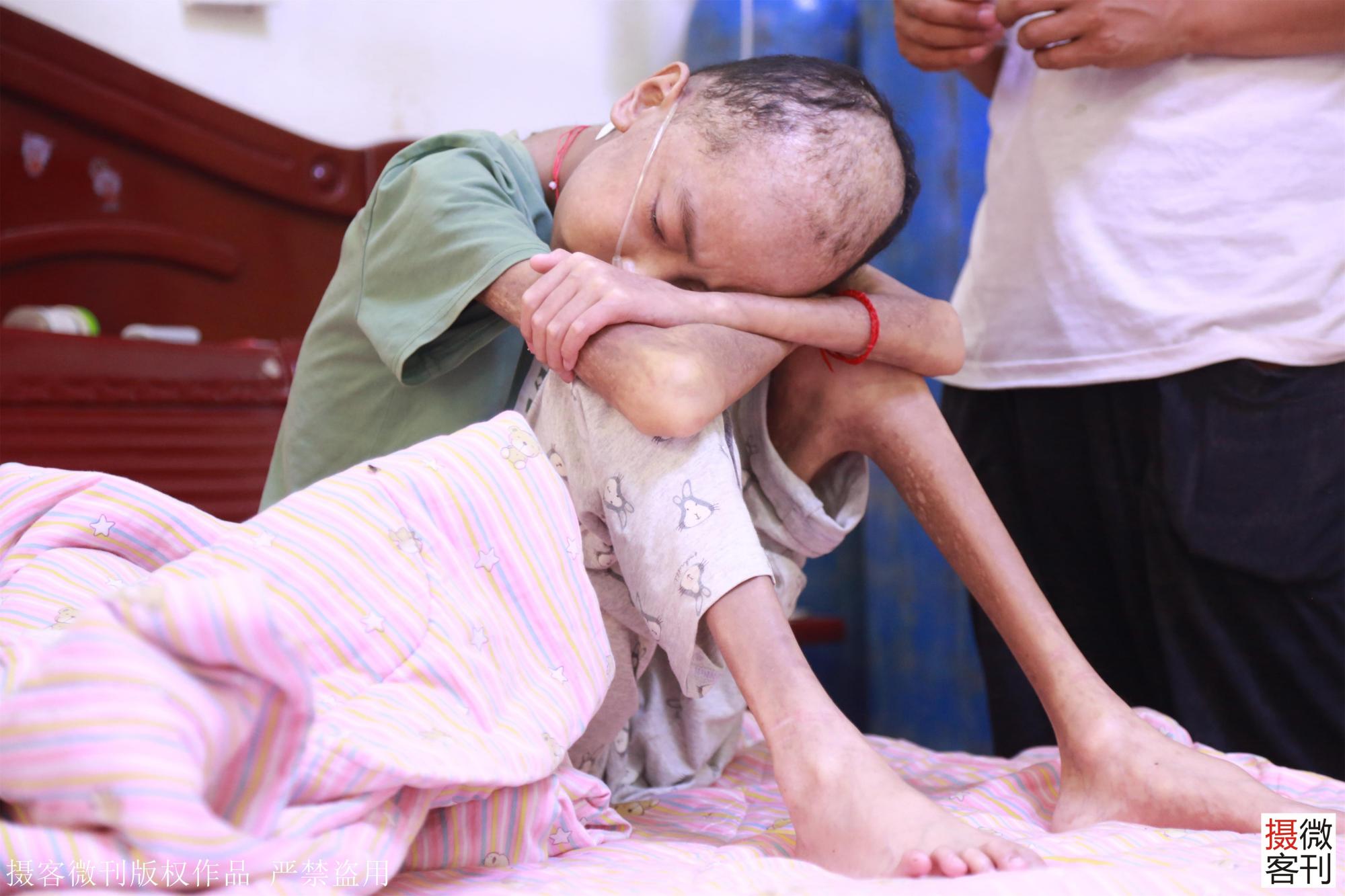 12岁男孩瘦成皮包骨24小时吸氧,姐姐掏鸡粪救患病弟弟