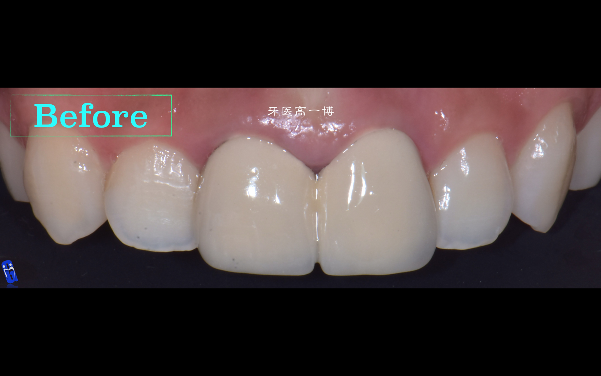 前牙牙冠再修复病例