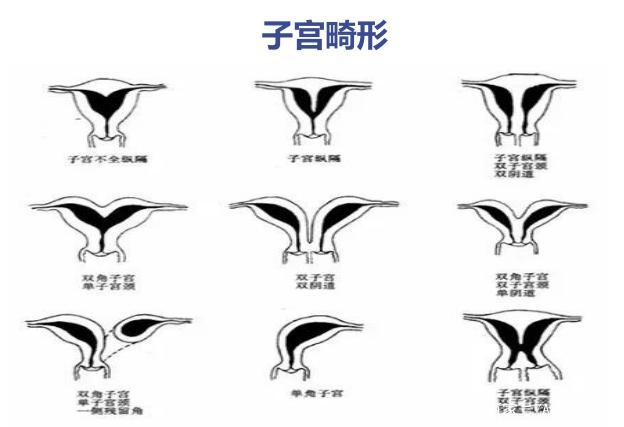 子宫形状 baijiahao.baidu.com