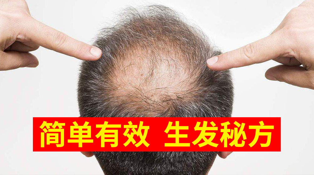 脱发掉发怎么办?自然丝育发来帮您!直播间讲解中!直播-养生直播-百度直播