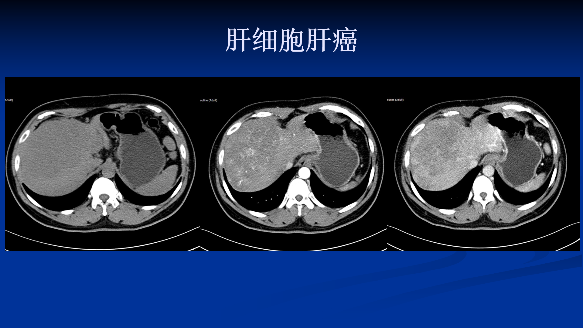 肝內膽管細胞癌ct及mri表現