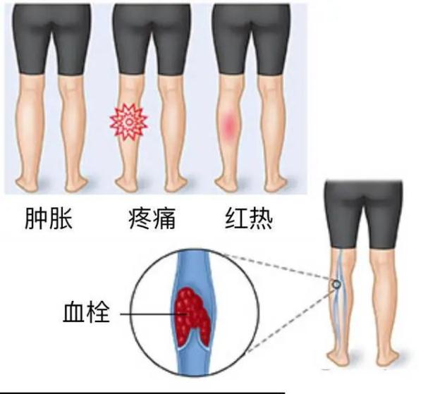 腿部血栓怎么办图片