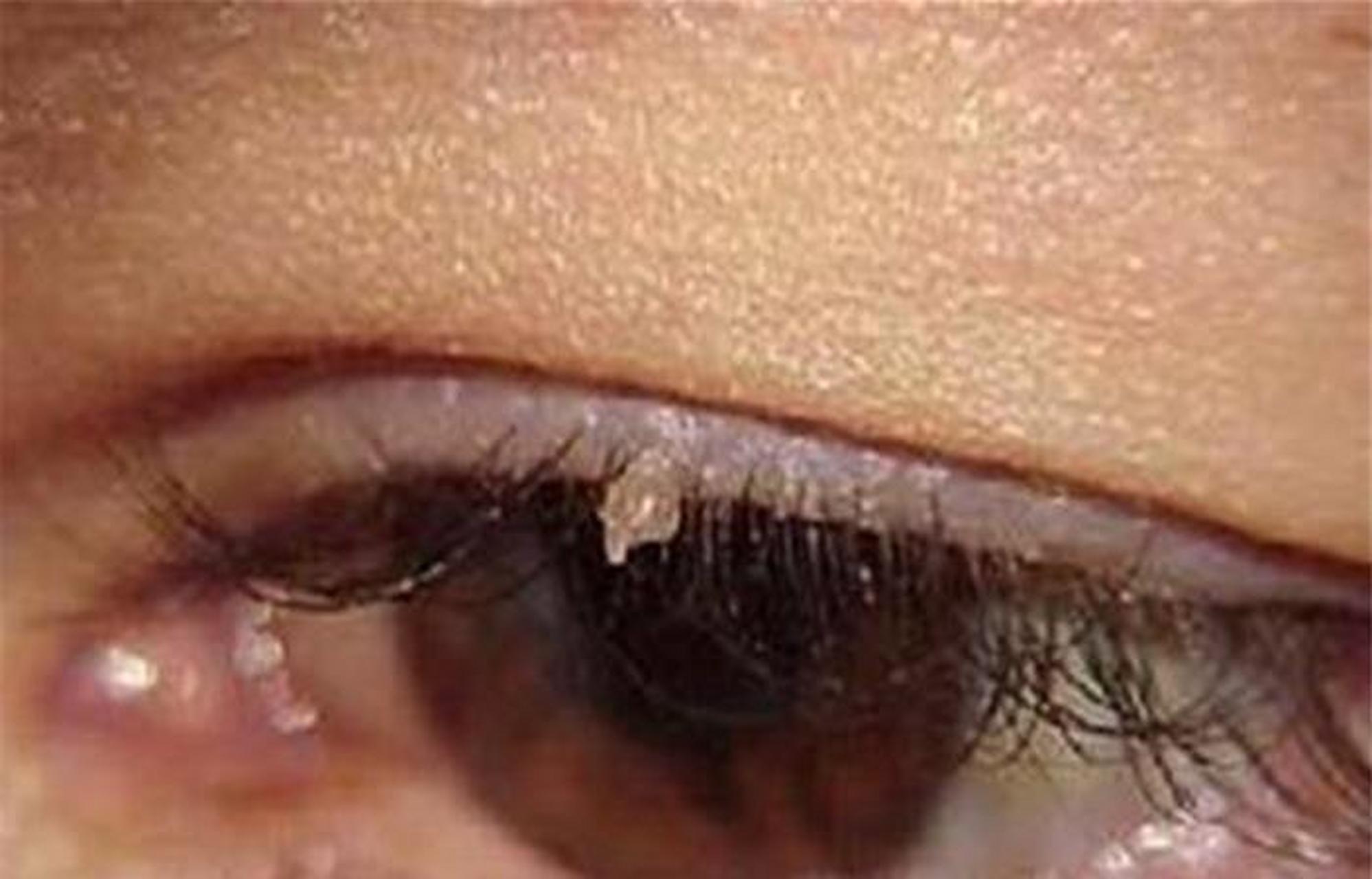 女子染hpv病毒脖子长"小肉疙瘩"#  近日,福州的陈女士不小心感染了