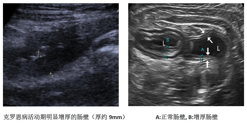 急性肠胃炎彩超图片