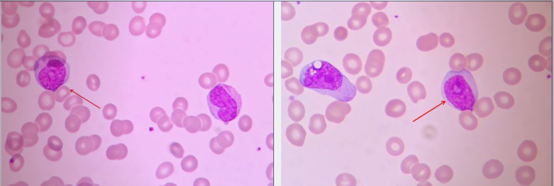 原幼单核细胞形态与诊断之间的微观探索