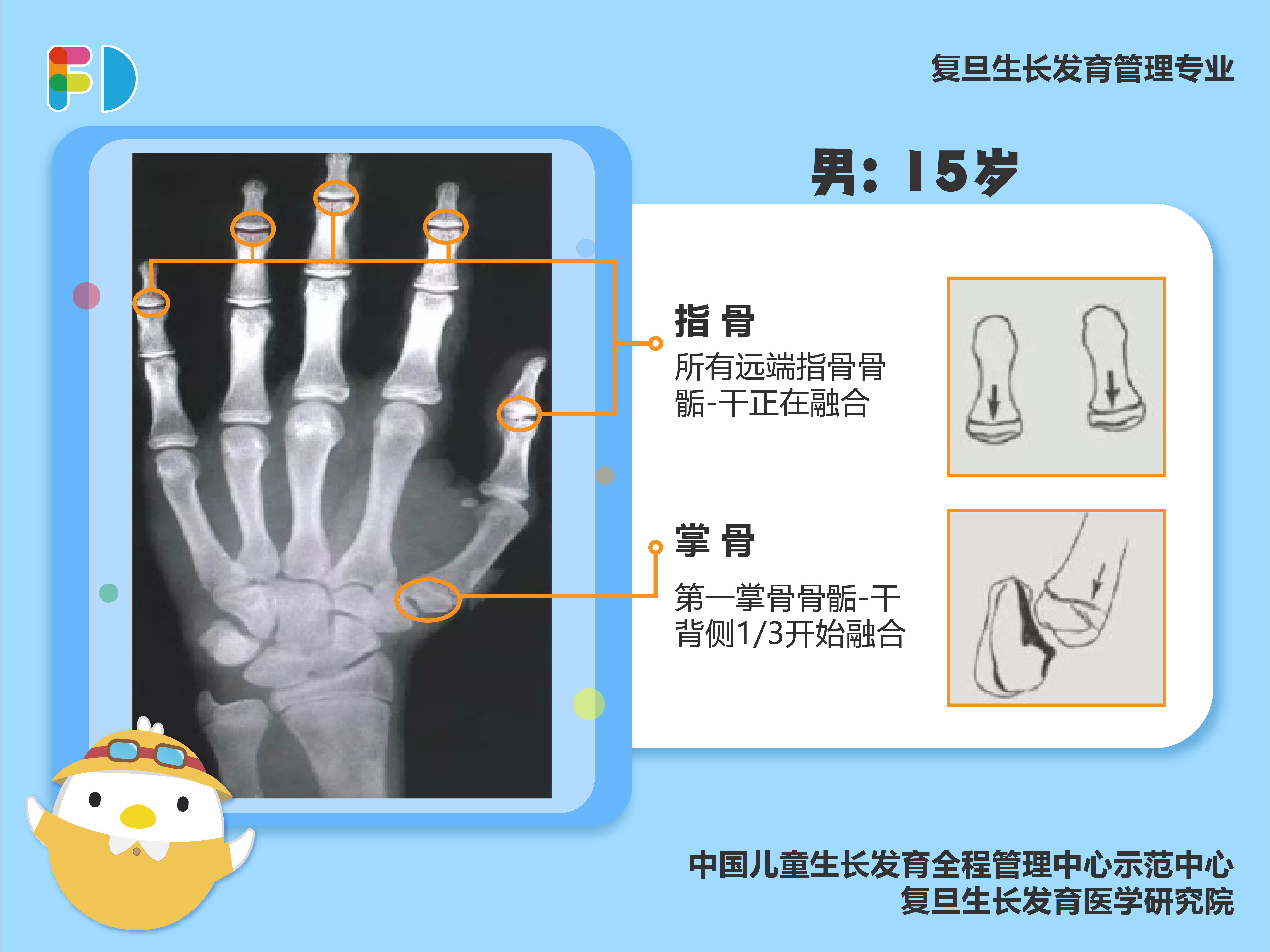 儿童骨龄对照表教你看懂儿童骨龄片