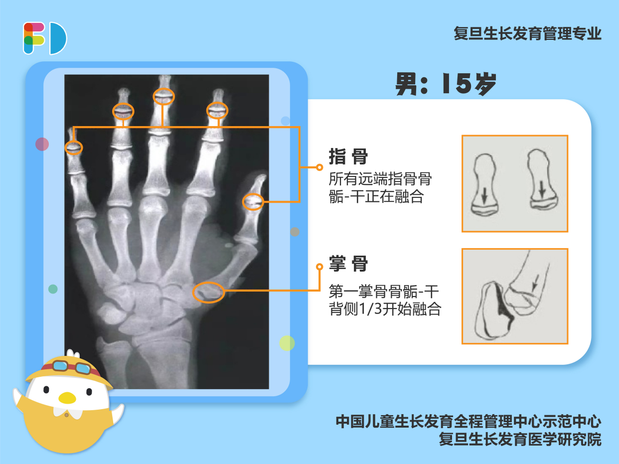 骨龄是骨骼年龄的简称,它是儿童生长发育水平的重要标志,也是判断儿童