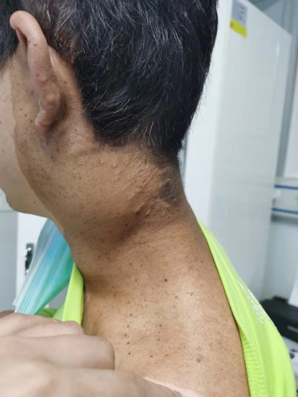 贵州省人民医院为1例左颈部神经纤维瘤患者,成功实施手术!